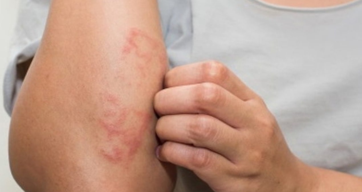 Erken tedavi edilmezse körlüğe neden oluyor