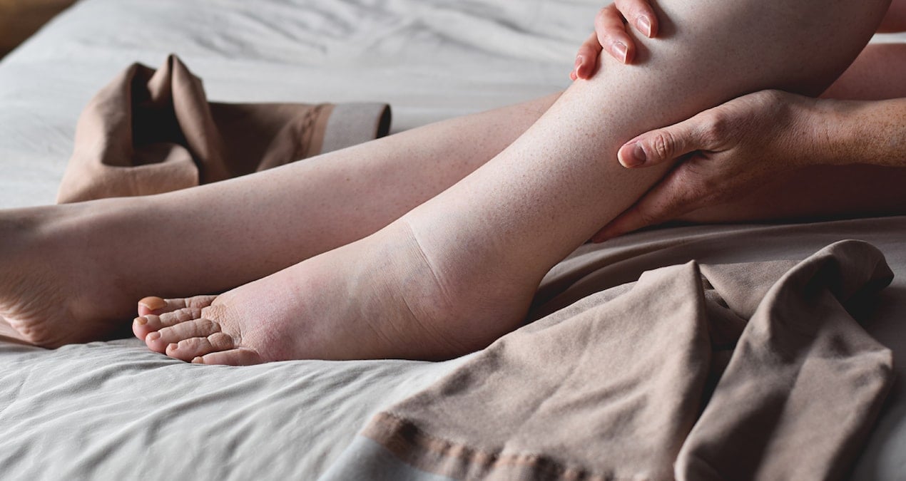 Vücudunuzdaki sinyallere dikkat: ‘Gizli salgın’ lenfödem alarm veriyor